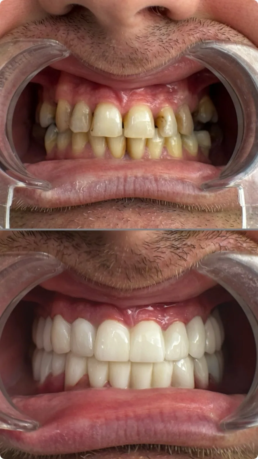 Prima e dopo faccette dentali in ceramica