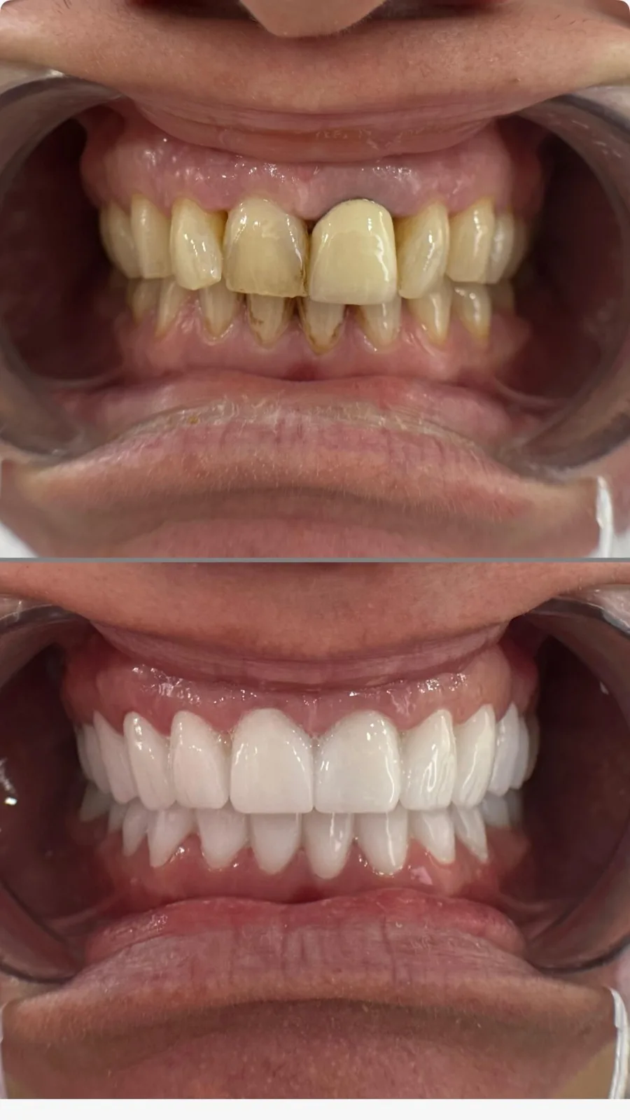 Caso di impianto singolo con corona in zirconia su dente anteriore.